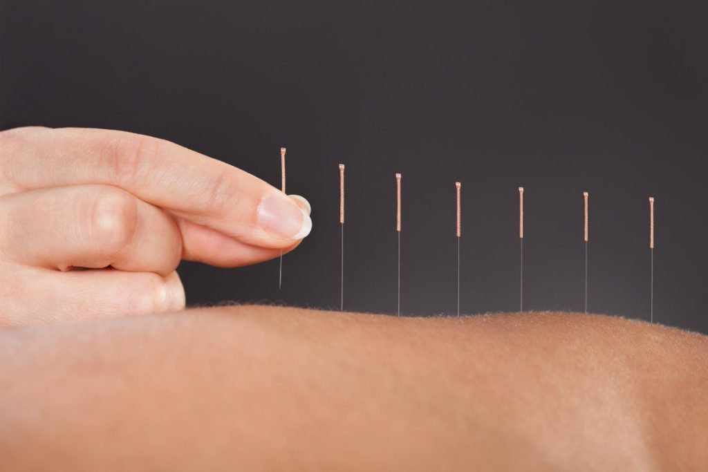 acupunctura